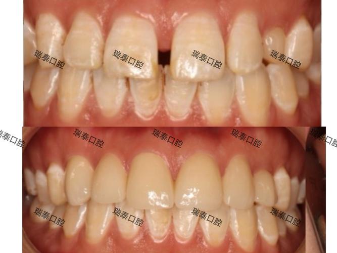 矫正牙齿收牙缝会疼吗？过程难受吗？-图1