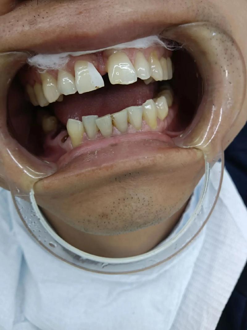 矫正牙齿收牙缝会疼吗？过程难受吗？-图2