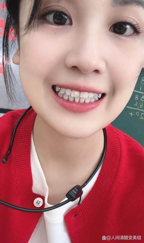 矫正完牙齿戴保持器-图1 矫正完牙齿戴保持器-图1