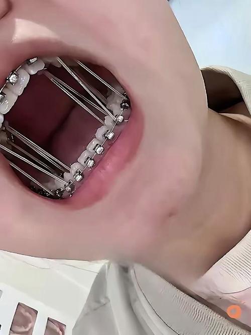 牙科诊所能矫正牙齿吗？效果与医院正畸有何差异？-图1