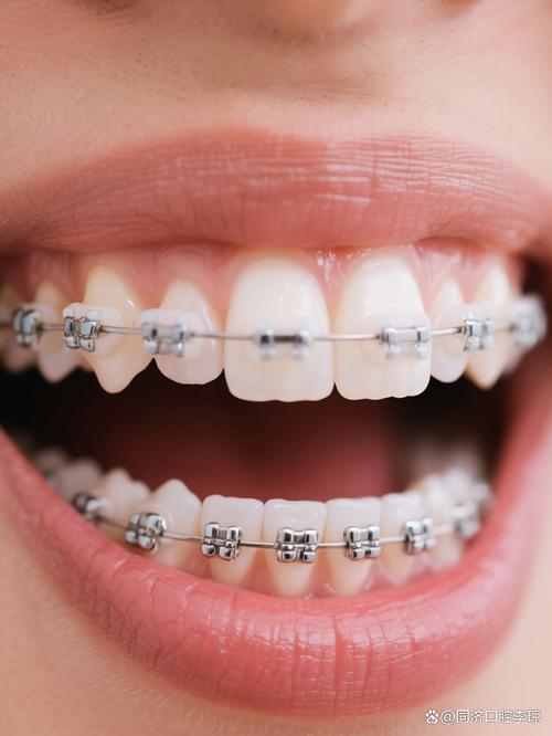 有虫牙还能做牙齿矫正吗？-图2