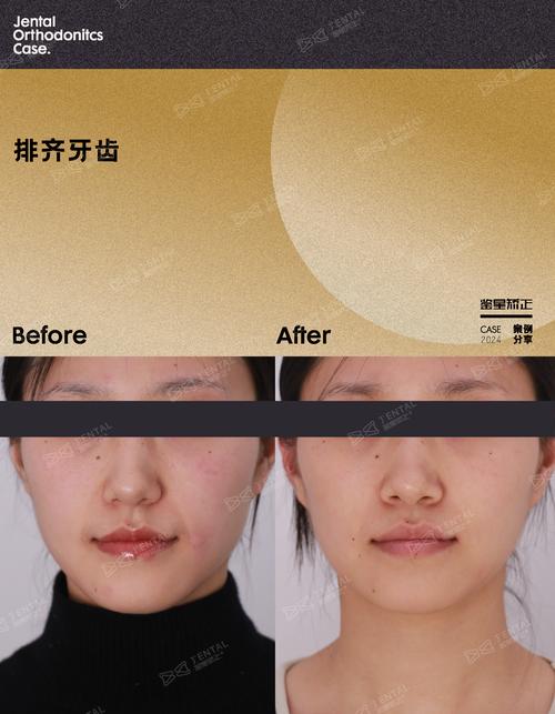 牙齿矫正前后对照图,为何变化效果如此显著?-图3 牙齿矫正前后对照图,为何变化效果如此显著?-图3