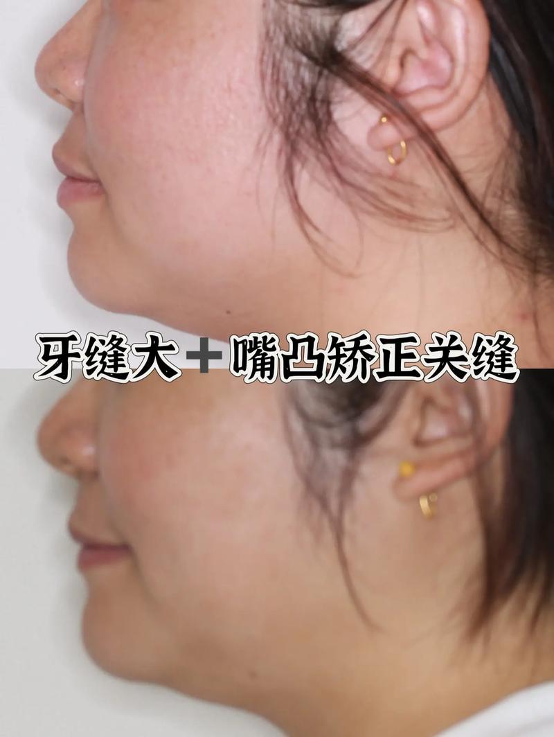 牙齿牙缝大能矫正吗-图2 牙齿牙缝大能矫正吗-图2