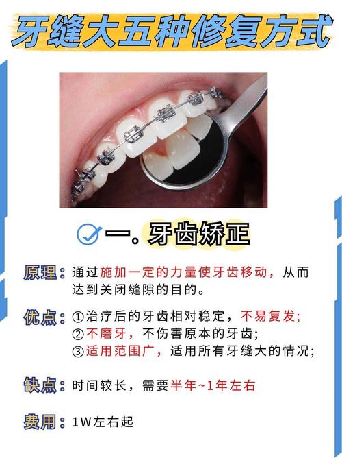 牙齿牙缝大能矫正吗-图1 牙齿牙缝大能矫正吗-图1