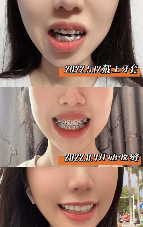 牙齿矫正没什么感觉？这是正常现象吗？-图1