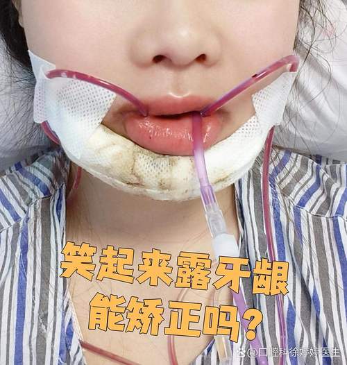 矫正牙齿会导致牙龈外露吗?-图2 矫正牙齿会导致牙龈外露吗?-图2