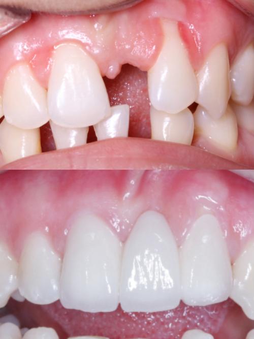 美容冠矫正牙齿对图-图1