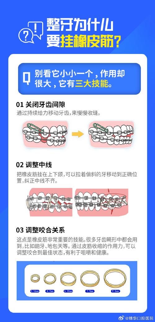 矫正牙齿橡皮圈图解-图2
