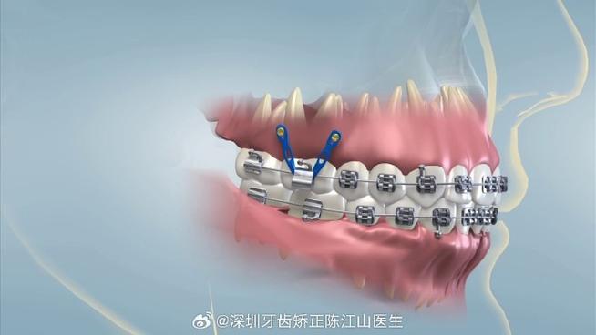 矫正牙齿打麻药疼不疼？-图2