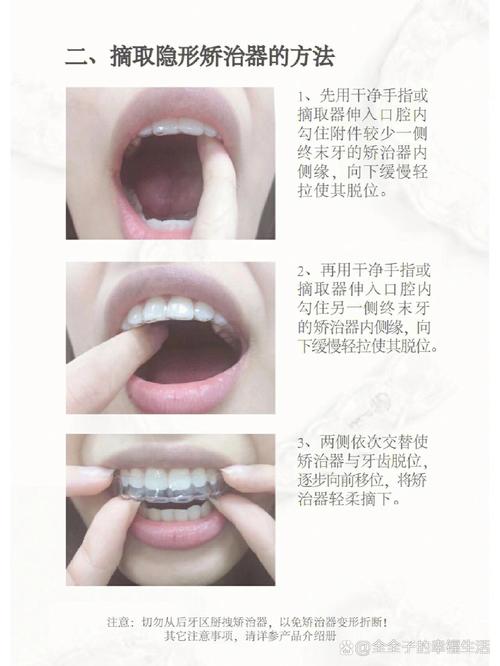 戴牙套矫正牙齿的具体佩戴步骤和流程是怎样的？-图3