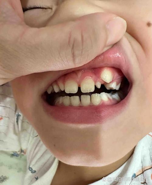 有虎牙能矫正牙齿吗？-图2