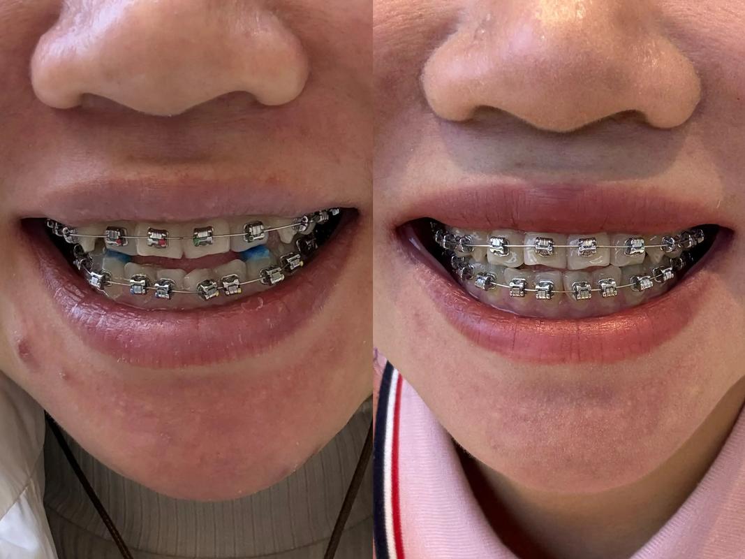 有虎牙能矫正牙齿吗？-图3