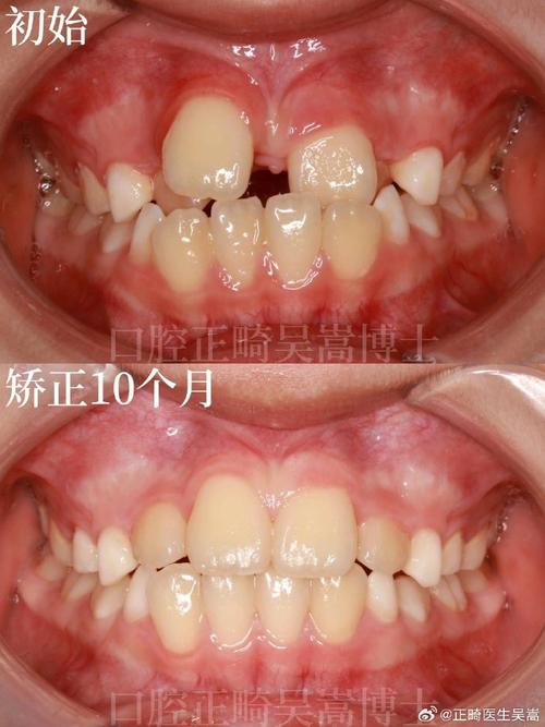 矫正牙齿牙缝合不上-图1