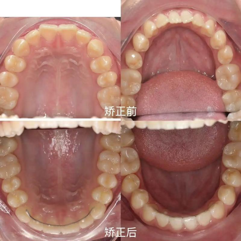 矫正牙齿牙缝合不上-图3