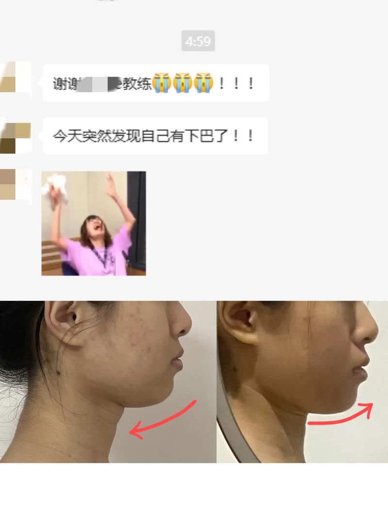 牙齿矫正下巴后缩短-图1 牙齿矫正下巴后缩短-图1
