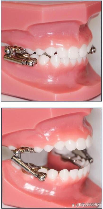德国进口牙齿矫正器效果好吗？安全有保障吗？适合哪些人？-图1