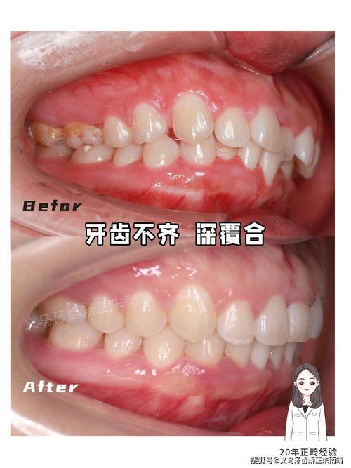 很不整齐的牙齿矫正-图3 很不整齐的牙齿矫正-图3