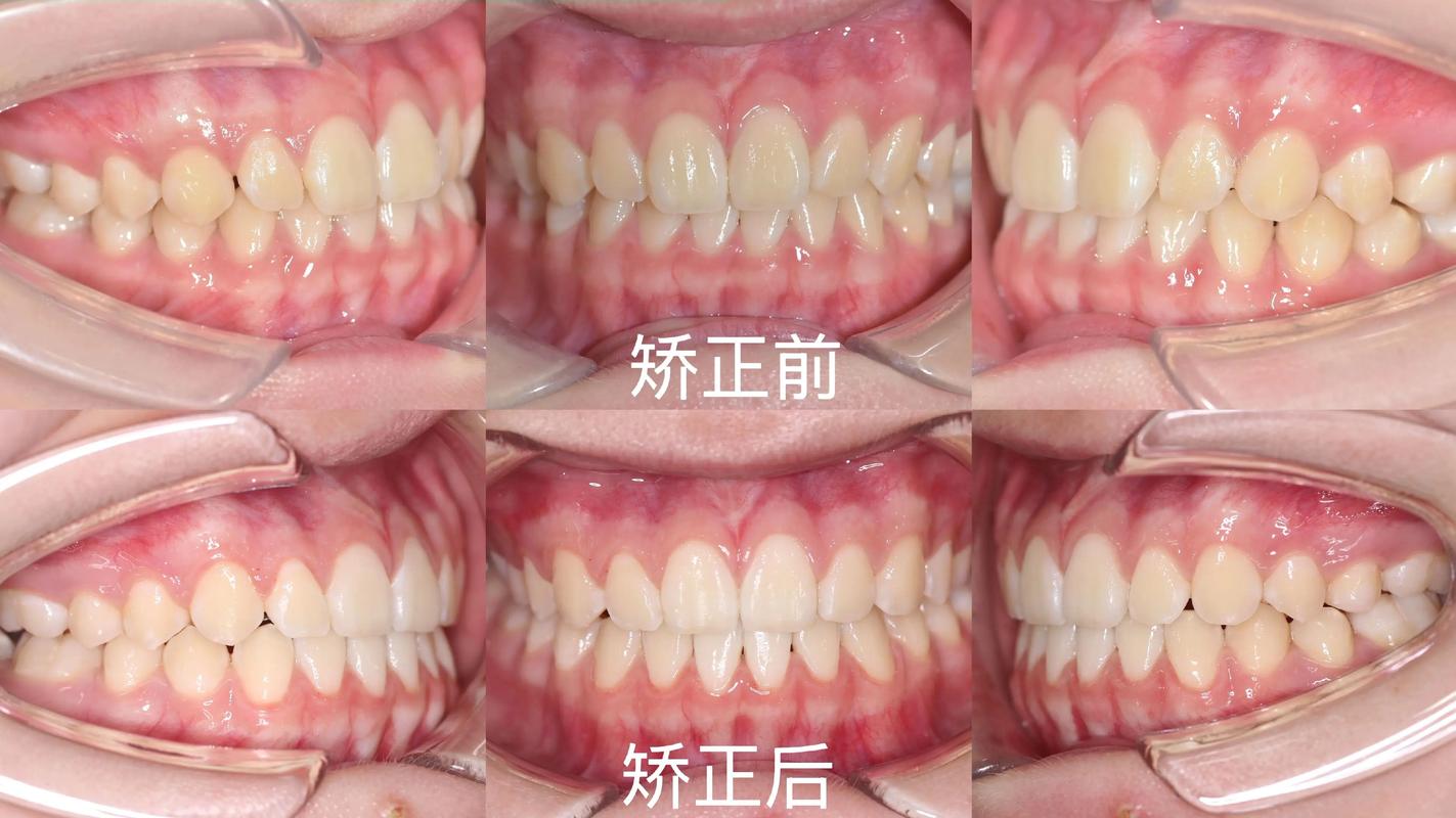 很不整齐的牙齿矫正-图2 很不整齐的牙齿矫正-图2