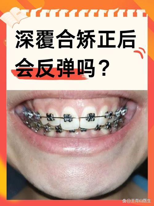 矫正过的牙齿，真的会反弹吗？-图2