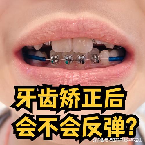 矫正过的牙齿，真的会反弹吗？-图3