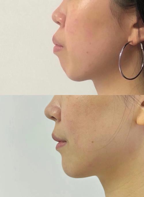 矫正牙齿脸会变小么-图1