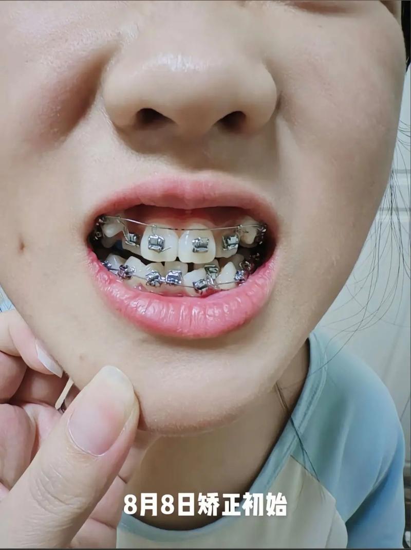 正畸矫正后牙齿松动-图2