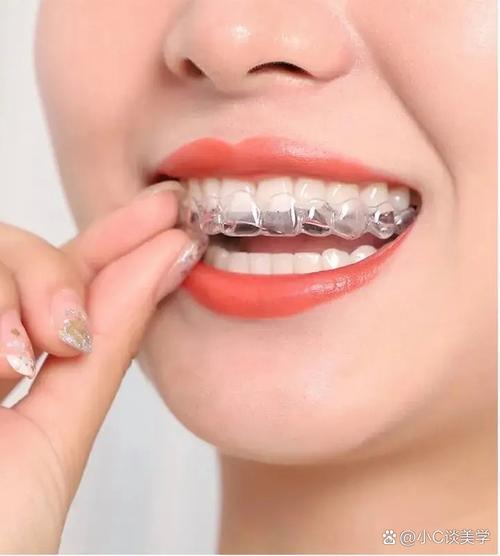 成都隐适美矫正牙齿效果如何?值得选吗?-图2 成都隐适美矫正牙齿效果如何?值得选吗?-图2