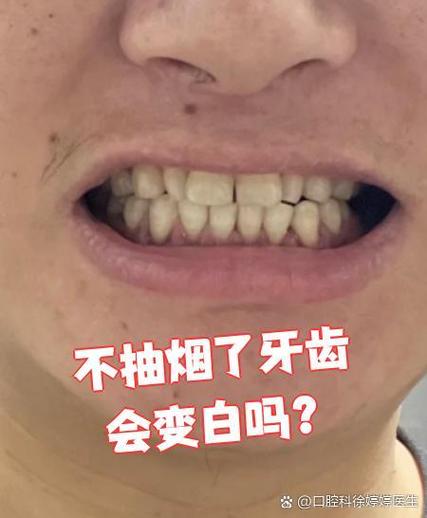 矫正牙齿后抽烟会影响矫正效果吗？-图2