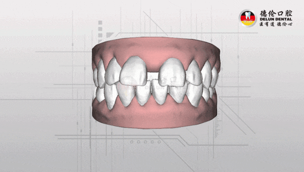 矫正牙齿过程动态图-图1 矫正牙齿过程动态图-图1