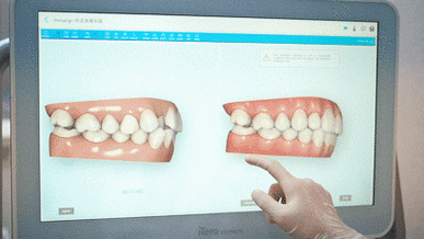矫正牙齿过程动态图-图2 矫正牙齿过程动态图-图2