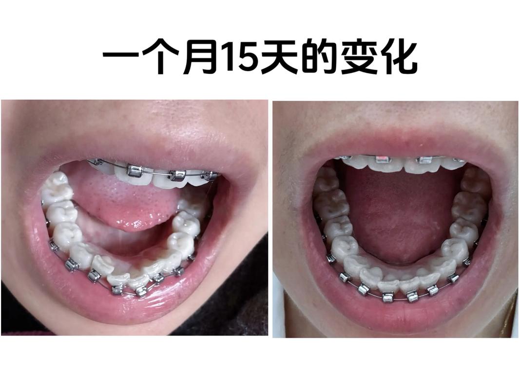 什么人适合矫正牙齿?这些情况该做吗?-图2 什么人适合矫正牙齿?这些情况该做吗?-图2