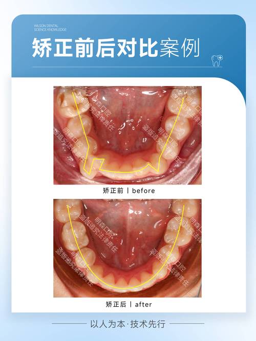 南山矫正牙齿哪家好?这几家医院靠谱吗?怎么选才合适?-图2 南山矫正牙齿哪家好?这几家医院靠谱吗?怎么选才合适?-图2