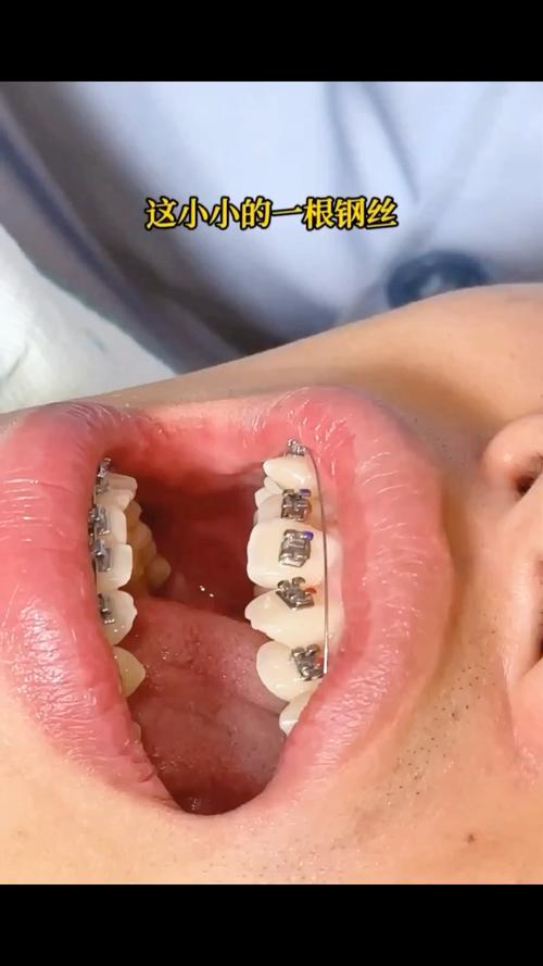 牙齿矫正多久更换一次钢丝?-图3 牙齿矫正多久更换一次钢丝?-图3