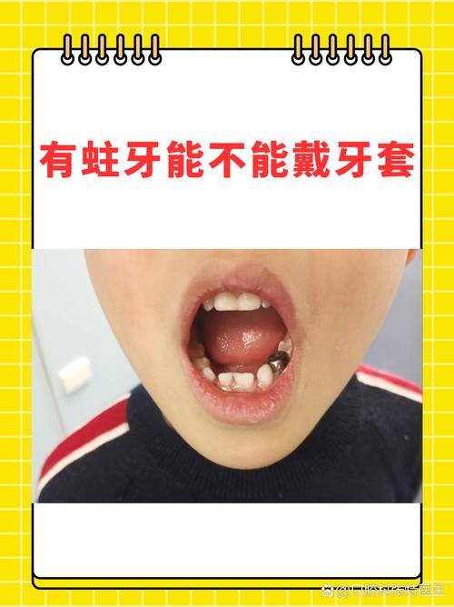 有龋齿还能做牙齿矫正吗？-图1