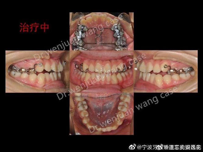 成都矫正牙齿哪家好？专业机构怎么选？-图2