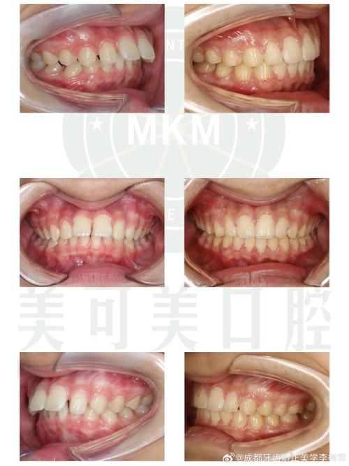成都矫正牙齿哪家好？专业机构怎么选？-图3
