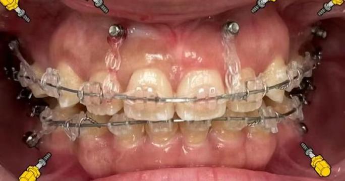 矫正牙齿不打支抗钉-图1