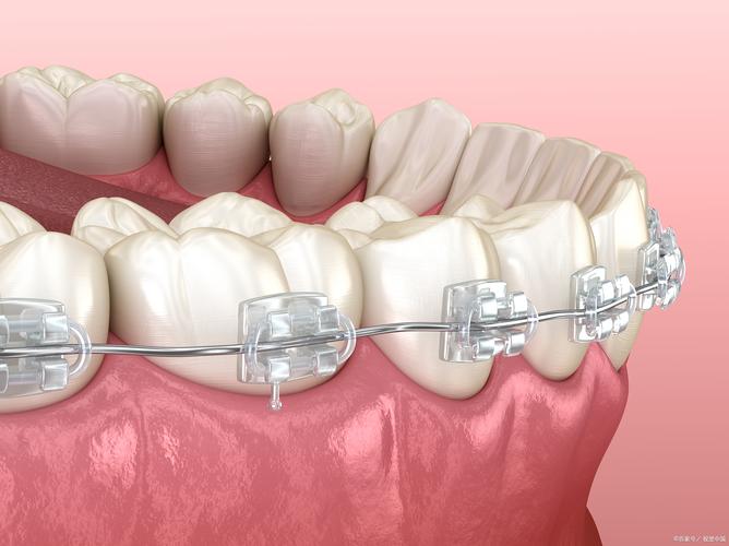 矫正牙齿金属和陶瓷选哪个好？-图3