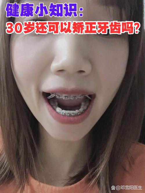 19岁矫正牙齿还正常吗？这个年龄做矫正合适吗？-图2