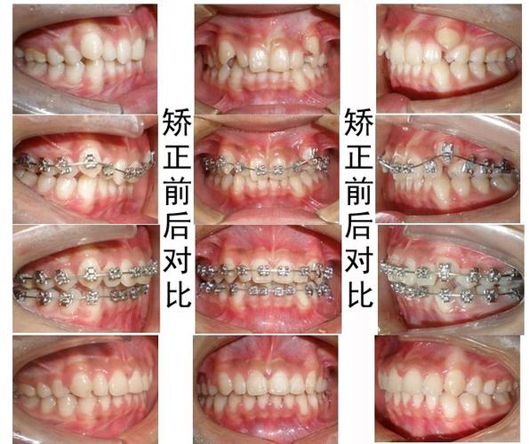 19岁矫正牙齿还正常吗？这个年龄做矫正合适吗？-图1