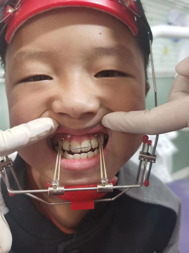 银川地包天矫正效果如何?能改善脸型吗?-图1 银川地包天矫正效果如何?能改善脸型吗?-图1