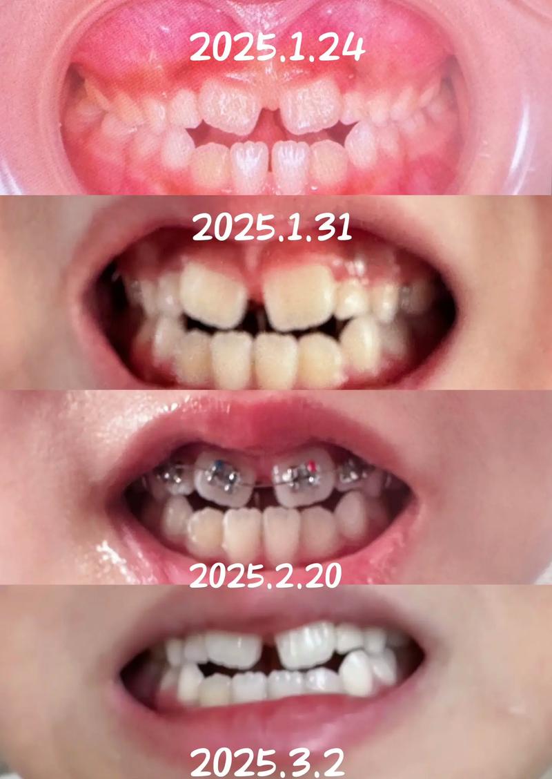 银川地包天矫正效果如何?能改善脸型吗?-图2 银川地包天矫正效果如何?能改善脸型吗?-图2