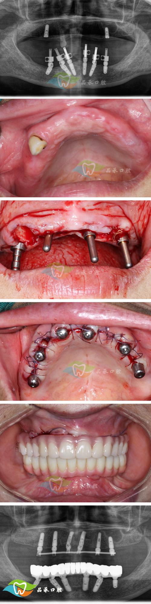 为什么手术矫正牙齿会后悔?后遗症真这么难熬?-图1 为什么手术矫正牙齿会后悔?后遗症真这么难熬?-图1