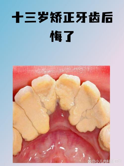 为什么手术矫正牙齿会后悔?后遗症真这么难熬?-图2 为什么手术矫正牙齿会后悔?后遗症真这么难熬?-图2