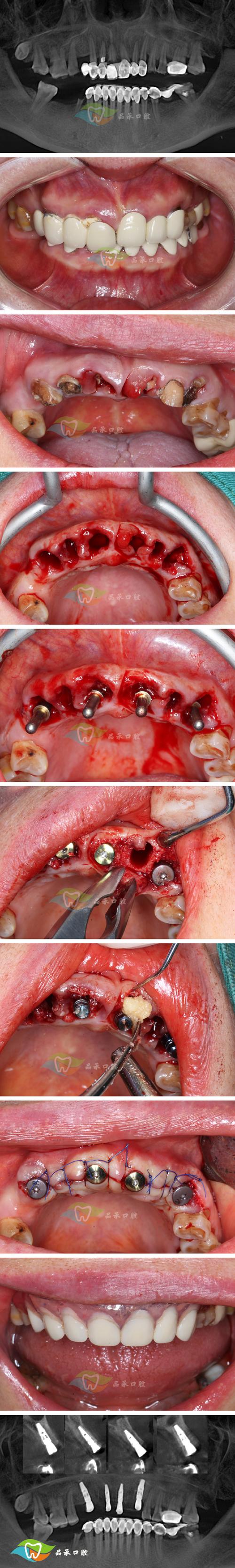 为什么手术矫正牙齿会后悔?后遗症真这么难熬?-图3 为什么手术矫正牙齿会后悔?后遗症真这么难熬?-图3