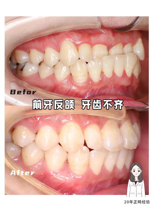 不用拔牙矫正牙齿，真的能不拔牙就变整齐吗？-图1