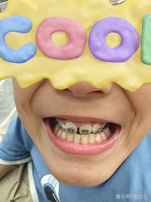 牙齿矫正门牙松动,是正常现象还是需警惕的问题?-图2 牙齿矫正门牙松动,是正常现象还是需警惕的问题?-图2