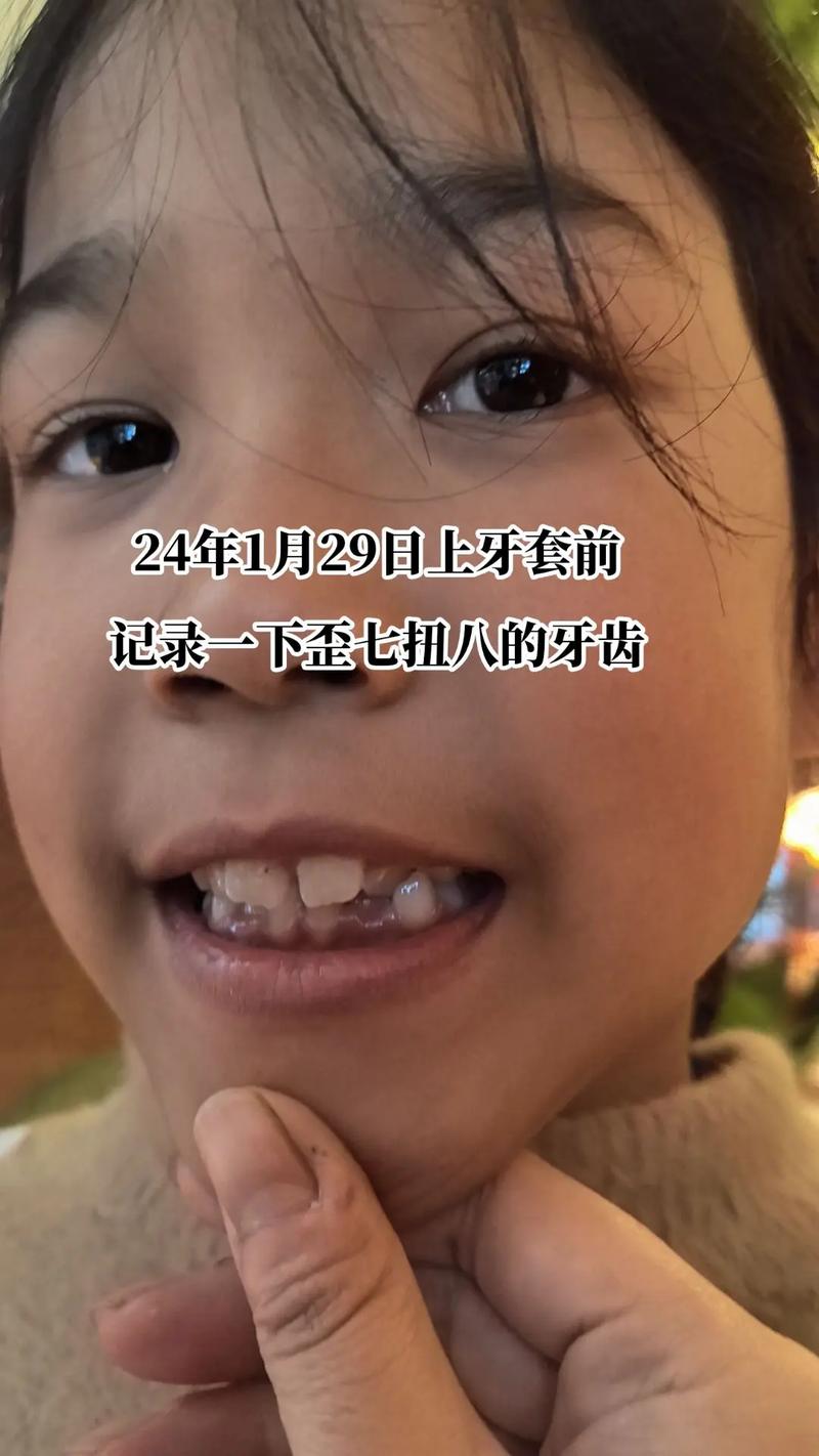 牙齿矫正门牙松动,是正常现象还是需警惕的问题?-图3 牙齿矫正门牙松动,是正常现象还是需警惕的问题?-图3