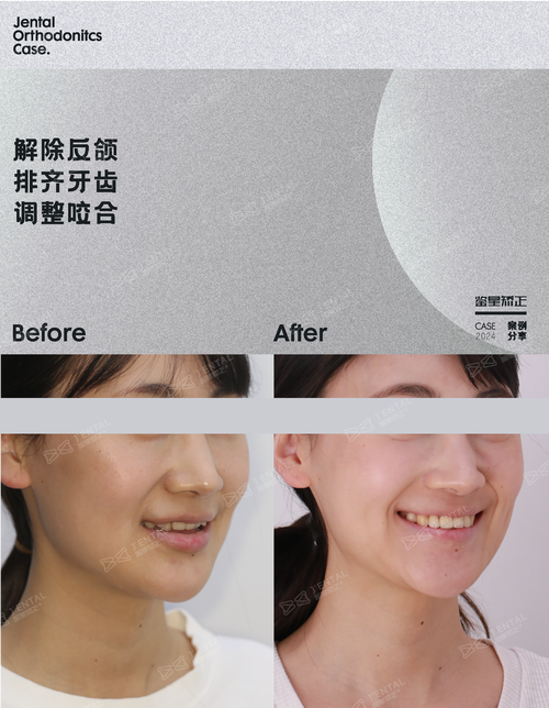 不拔牙矫正可行吗？效果会打折扣吗？-图3
