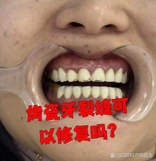 矫正牙齿后出现缝隙-图3